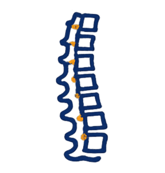 Sciatica